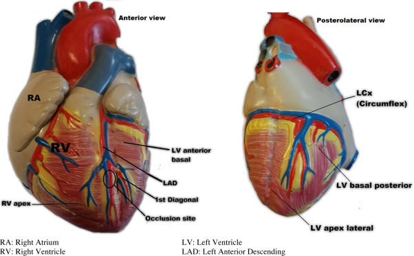 Multisite Pacing in Intact Myocardium and after Acute Myocardial Infarction: Experimental Study