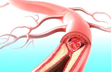 Acute Arterial Occlusion after Treatment of Heart Failure