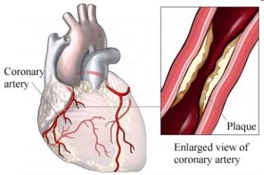 Statistical Methods of ECG Signal Processing in Diagnostics of Coronary Artery Disease