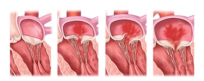 Procedural and Clinical Results of the New MitraClipÂ® NT after Percutaneous Edge to Edge Repair of Mitral Valve Regurgitation