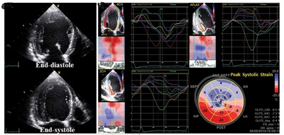 Predictors for Left Ventricular Systolic Dysfunction and its Outcome after Patent Ductus Arteriosus (Pda) Closure by Device