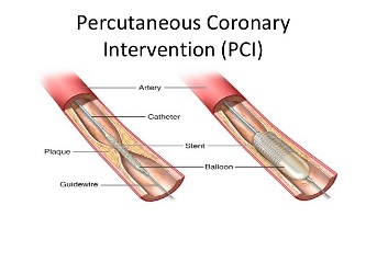 Near East Acute Coronary Syndromes Percutaneous Coronary Intervention Patients at One Year