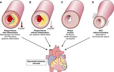 Defining Contrast-Induced Acute Kidney Injury Based on KDIGO (Kidney Disease: Improving Global Outcomes) Criteria Predicts Midterm Outcomes after Primary Percutaneous Coronary Intervention for Patients with Acute Coronary Syndrome