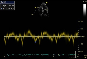 Study of Left Ventricular Function in Diabetic Patients with Normal Ejection Fraction: Evaluation by Tissue Doppler and Speckle Tracking Echocardiography