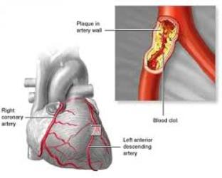Troponin and St Segment Elevation in a Diabetic Ketoacidosis Patient without Acute Coronary Syndrome