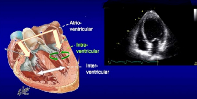 Assessment of Left Ventricular Dyssynchrony using Gated Myocardial Perfusion SPECT in Cardiac Resynchronization Therapy