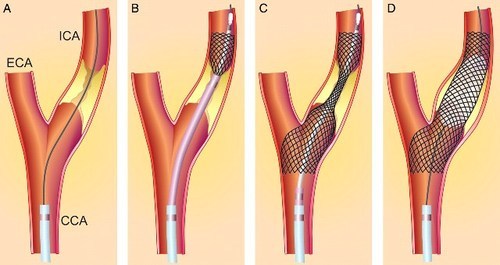 Longitudinal Retrospective Study with over 500 Participants Shows Main Continuous Predictors for Angioplasty: Clinical Trial