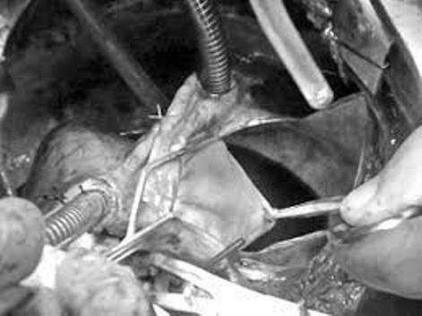 Atrial Plication with Appendage Obliteration during MVR, in Huge Left atrium, Early Outcome