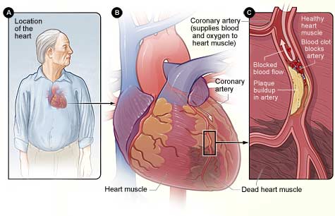 Comparison between GRACE and TIMI Risk Scores in Predicting the Severity and Extent of Coronary Artery Disease in Patients with NSTEACS