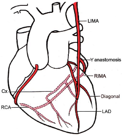 Impact of Bilateral Internal Mammary Artery Grafting on the Immediate Outcome: A Double-Edged Sword in a Low Volume Heart Centre