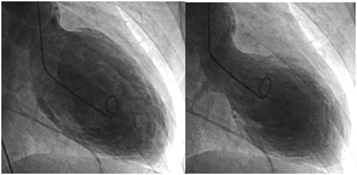 Septal Bulge as a Cause of Tako-Tsubo Syndrome