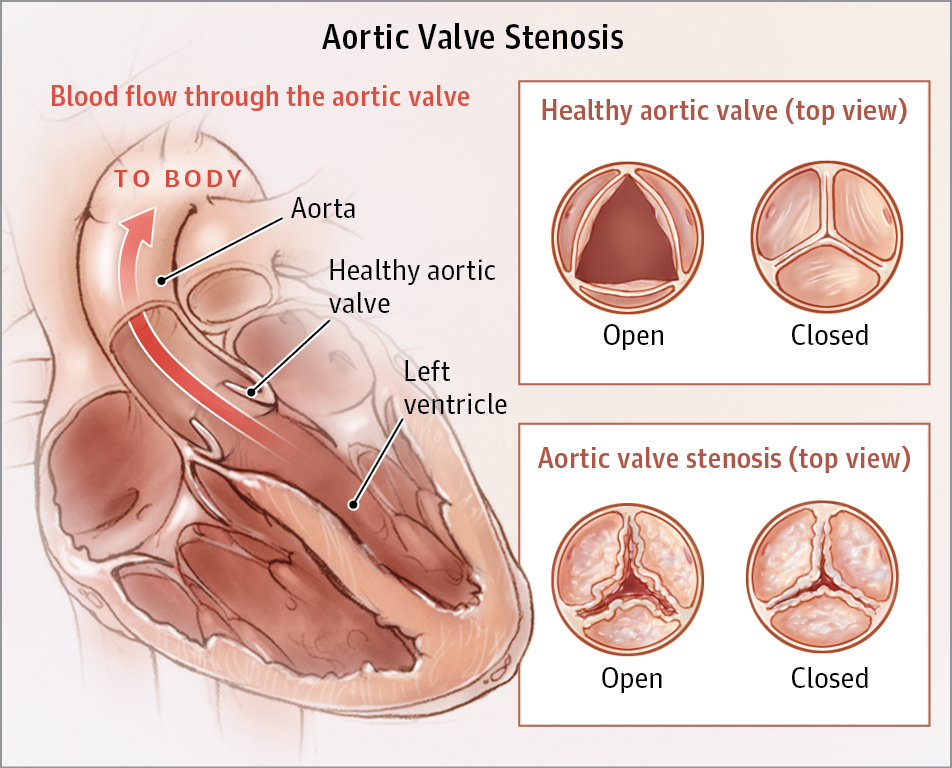 Minimal Access Techniques in Aortic Root Surgery