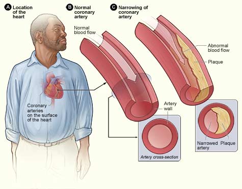 Risk Factors of Coronary Artery Disease among Male Teachers in Saudi Arabia, Almadinah City