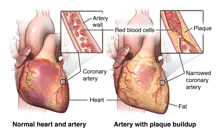 Serum Adiponectin Levels and Severity of Coronary Artery Disease by Gensini Score