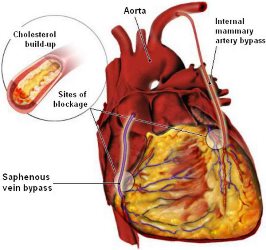 Immediate Proximal Coronary Graft Anastomosis after Completion of Related Distal Anastomosis, During Off Pump Cabg; Is It Efficient?