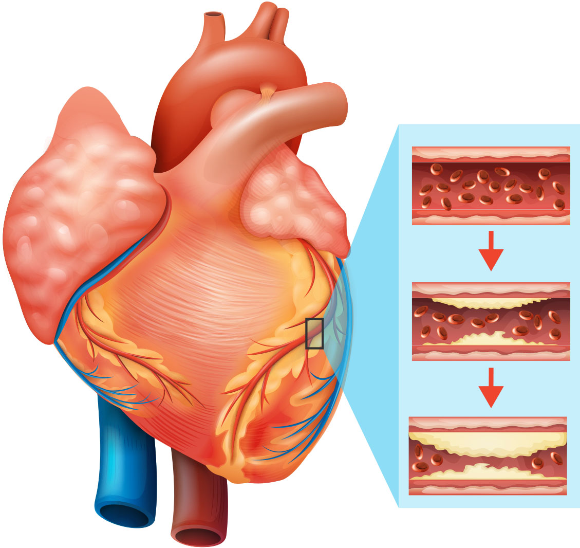 Patterns in Risk Factors of Cardiovascular Disease using the Apriori Algorithm