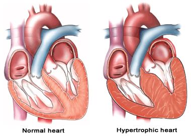 Validation of Cornell Product as a Method of Assessing Left Ventricular Hypertrophy