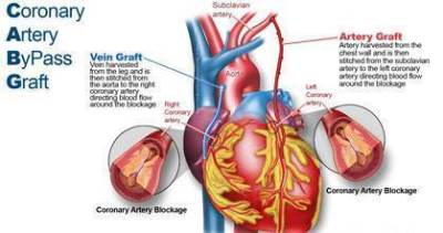 Preoperative Platelet Activation Markers as a Risk Predictor of Postoperative Atrial Fibrillation after Coronary Artery Bypass Grafting