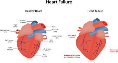 Atypical Myocardial Infarction: Beware Misdiagnosis of Acid Peptic Disease