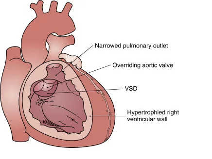 Surgical Management of Tetralogy of Fallot with Inadequate Size Pulmonary Artery Branches