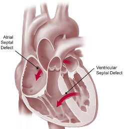 Physical Fitness Study in Children with Previous Surgery for Congenital Heart Disease