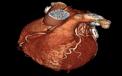 Correlation of Within-Plaque Inflammatory Biomarkers with Coronary Plaque Subtypes Categorized by Contrast-Enhanced Coronary Computerized Tomography