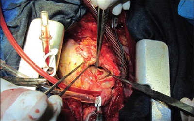 Aorto-Cavitary Fistulae to Streptococcal Endocarditis