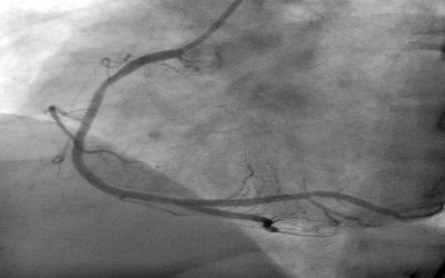 Could you Survive a Killer Bubble? Coronary Air
Embolism