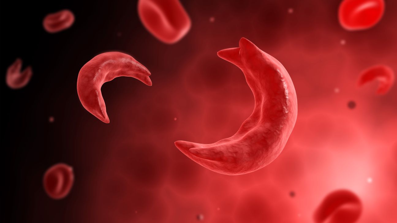 Sickle Cell Disease and Posterior Reversible Leukoencephalopathy