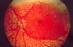 Short note on Diabetic Retinopathy