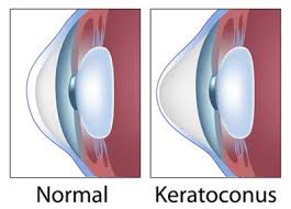 Successful Treatment of Keratoconus using Allogenic Fresh Myopic Lenticule Implantation and Autologous Serum