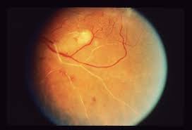 Successful Clinical and Demographic Profile of Vasculitis Retinae in a Tertiary Eye Care Centre of Bangladesh