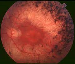 Intracranial Pressure and Retinitis Pigmentosa