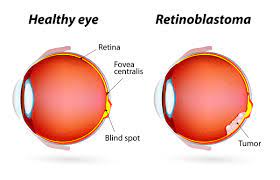 Trilateral Retinoblastoma with Spinal Metastases