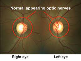 Corticosteroids in the Treatment of Atypical Optic Neuritis