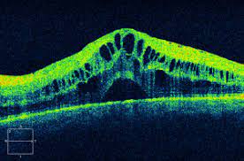 Internal Anterior Chamber Diameter and Depth Measurement for Phakic Intraocular Lens