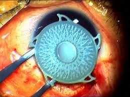 Morcher Artificial Iris Diaphragms and its Clinical Evaluation