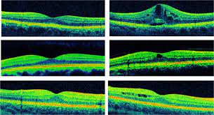 Postoperative Nonsteroidal Anti-Inflammatory Drug Use for Prevention of Cystoid Macular Edema in Low-Risk Patients