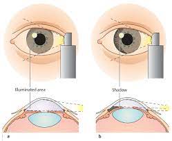 Surgical Considerations and Interventions and its Importance Regarding Anterior Chamber Depth