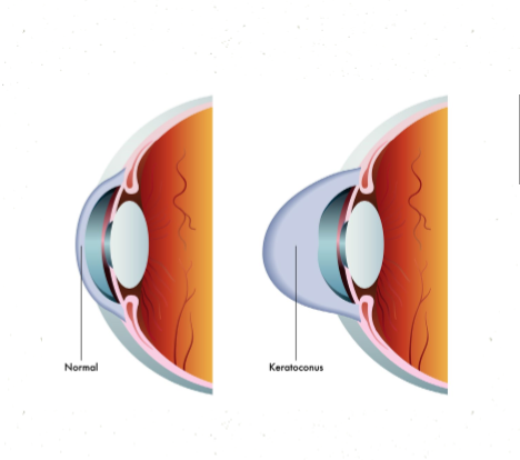 Keratoconus screening in Basic School Children using keratoconus suspect criteria in Aljaded Althawra (Aljazeera State)