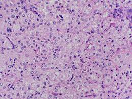 Rosai-Dorfman Disease of the Orbit � Review of a Case and Review of Literature