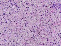 Rosai-Dorfman Disease of the Orbit  Review of a Case and Review of Literature