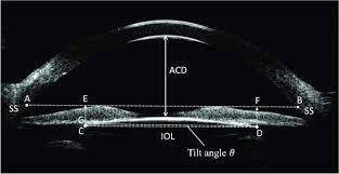 Anterior Chamber Depth Characteristics Clinical and Modifying Factors