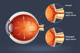 Corneal Hysteresis and its Association with Optic Nerve and Visual Field Damage in Glaucoma