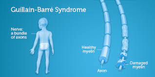 Guillain-Barré and Miller Fisher syndrome associated with SARS-CoV-2