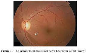 Changes in Peripapillary Retinal Nerve Fibre Layer Thickness in Healthy Myopic Eyes