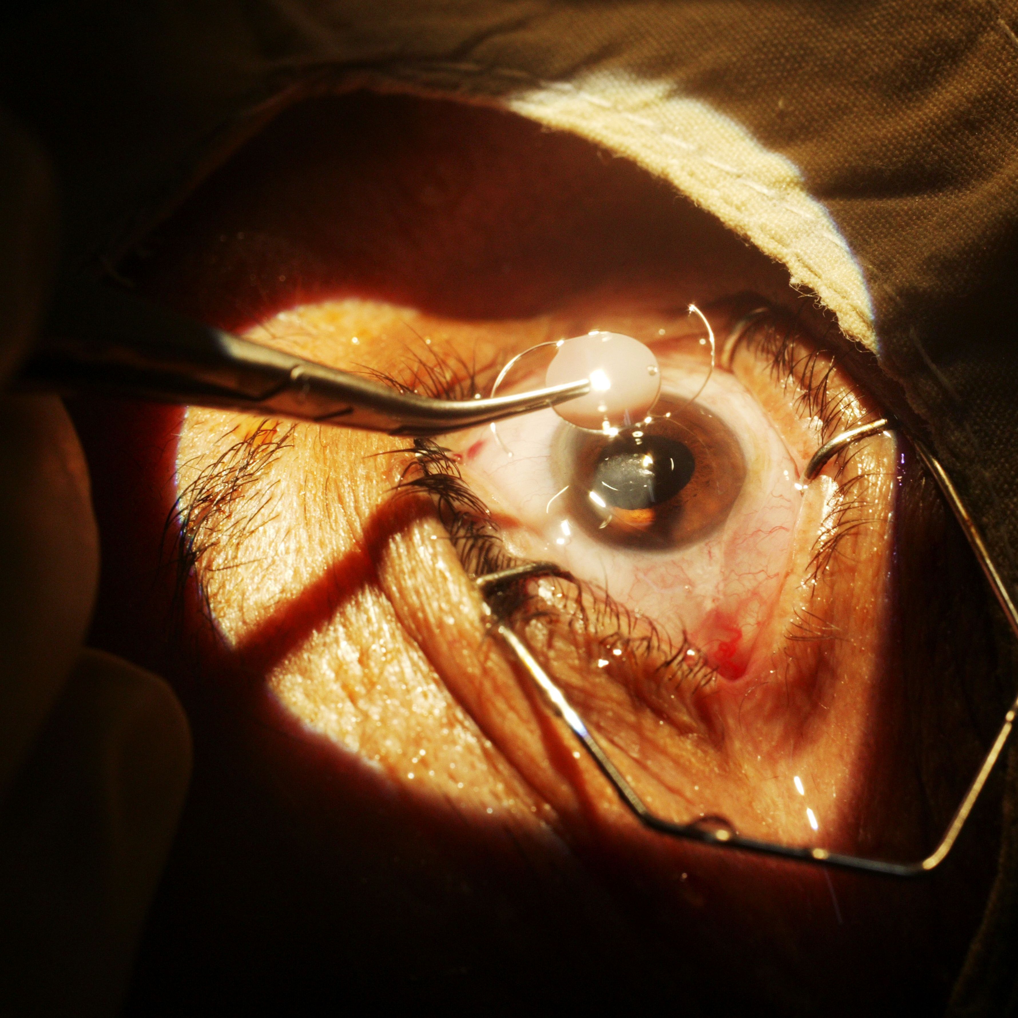 Changes in Intraocular Pressure after Cataract Surgery in Yaounde