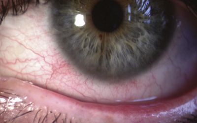 Nonspecific Orbital Inflammation: Atypical Case Report