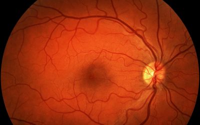 Progression and Incidence of Geographic Atrophy in Patients with Wet Age-Related Macular Degeneration undergoing Anti- VEGF Therapy