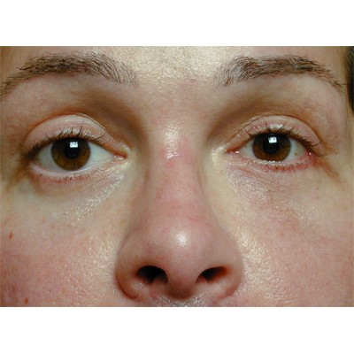 Pseudo-Duane’s Retraction Syndrome Associated with Medial Wall Trapdoor Orbital Fracture